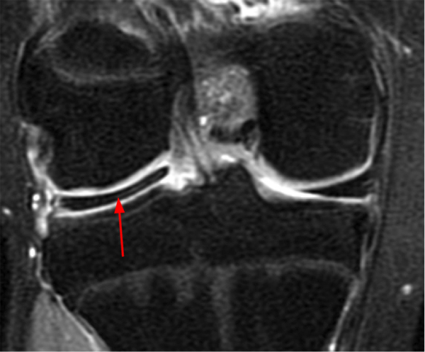 Hypermobile Lateral Meniscus - Radsource