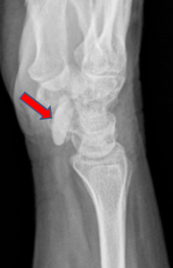 Densely calcified lesion