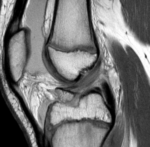 Today’s Interesting Case: ACL Tibial Avulsion Fracture