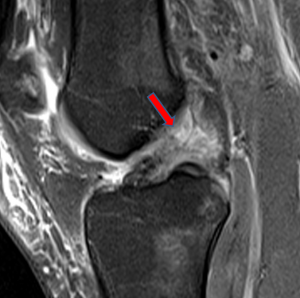 MRI Knee Dislocation