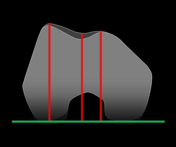Anterior–posterior trochlear measurements