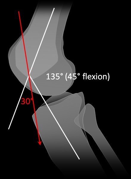 Techniques for axial radiography of the knee