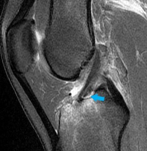 Avulsion of the ACL