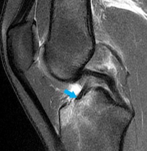 anterior medial bundle fibers of the ACL
