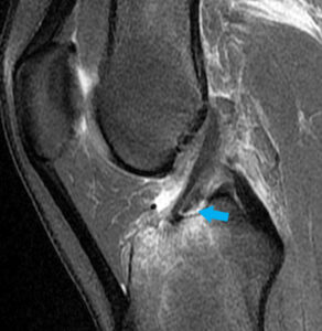 Today’s Interesting Case: Tibial Eminence Fracture