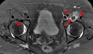 edema surrounding the torn left iliopsoas tendon