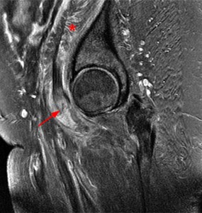the torn and retracted iliopsoas tendon