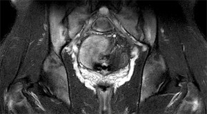 Coronal T2 fat-suppressed MR image of the pelvis