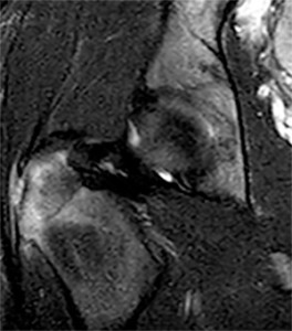 Coronal T2 fat-suppressed MR image of the right hip
