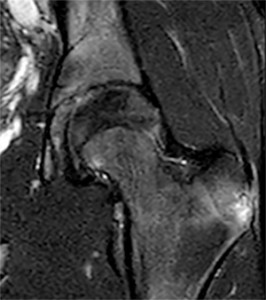 Coronal T2 fat-suppressed MR image of the left hip