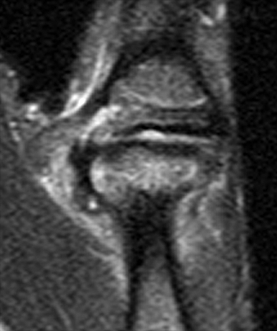 ulnar collateral ligament thumb mri