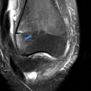 the anterolateral aspect of the lateral femoral condyle