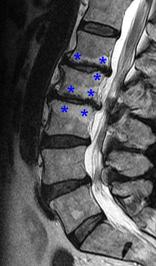 Boyun Fıtığı ‘Servikal Disk Hernisi’ - Beyin, Omur ve Omurilik Cerrahisi Uzmanı