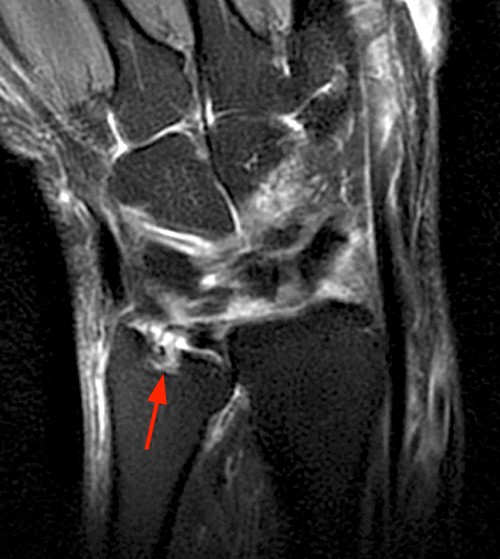 rheumatoid arthritis radiology mri