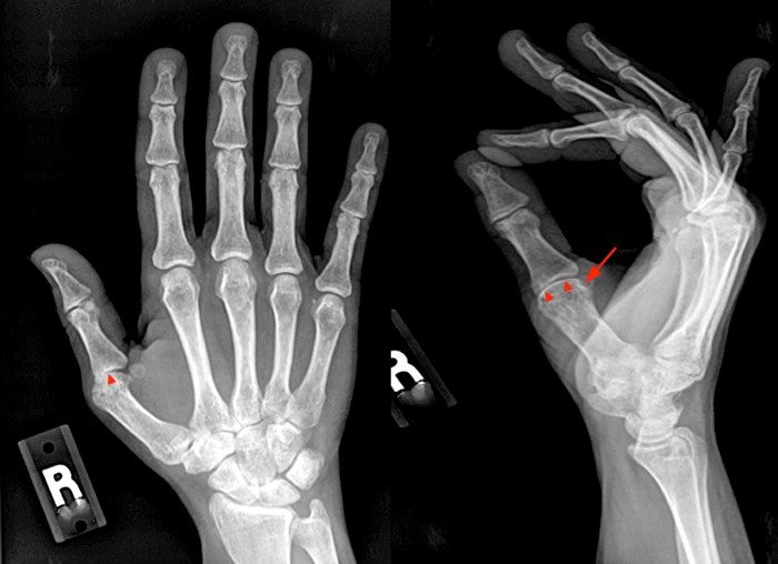 stroke - radiology - Rheumatoid arthritis radiology findings