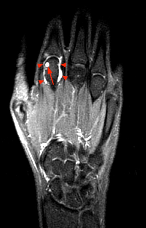 rheumatoid arthritis radiology mri)