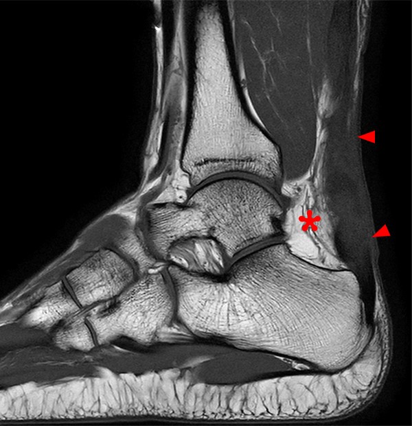 Magic angle artifact of a normal Achilles tendon