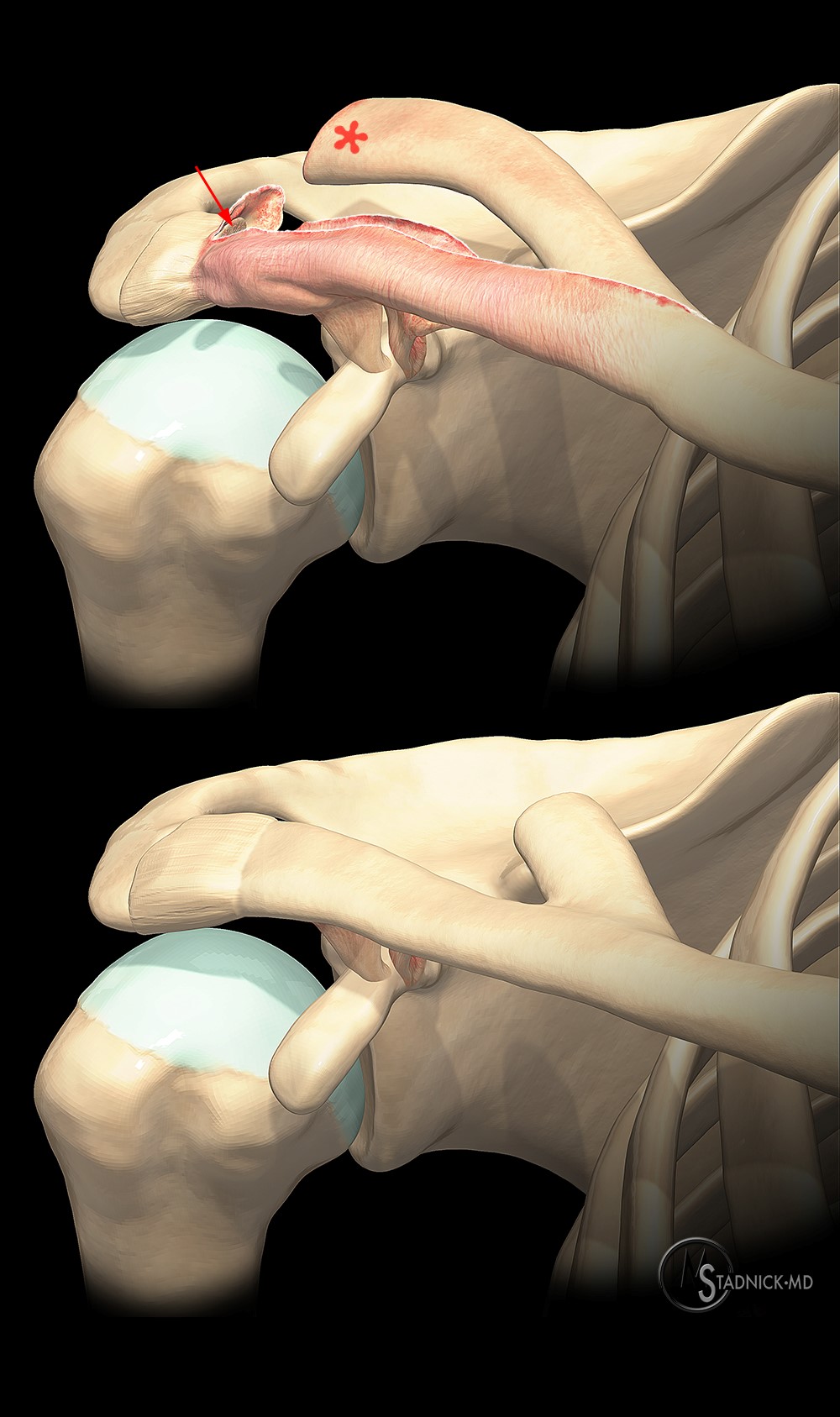 deteriorarea articulației acromioclaviculare de 1 grad unguent pentru articulația degetului mare