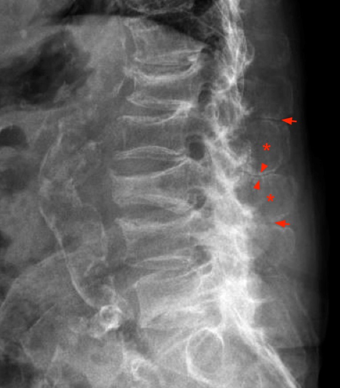 Lateral lumbar spine radiograph, figure 4