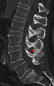 Sagittal reconstructed CT image, 5a