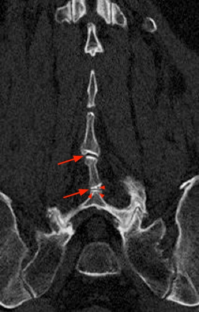 Coronal reconstructed CT image, 5c