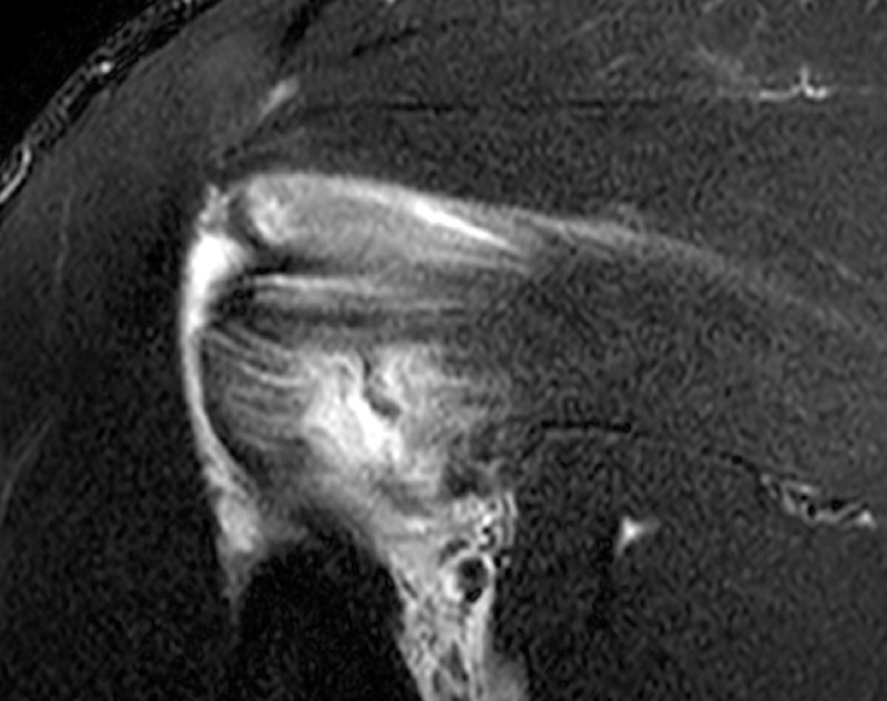 shoulder, T2-weighted coronal images