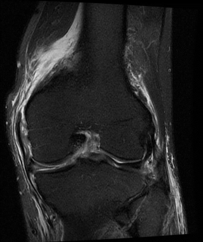 Medial Supporting Structures Of The Knee With Emphasis On The Medial Collateral Ligament Radsource