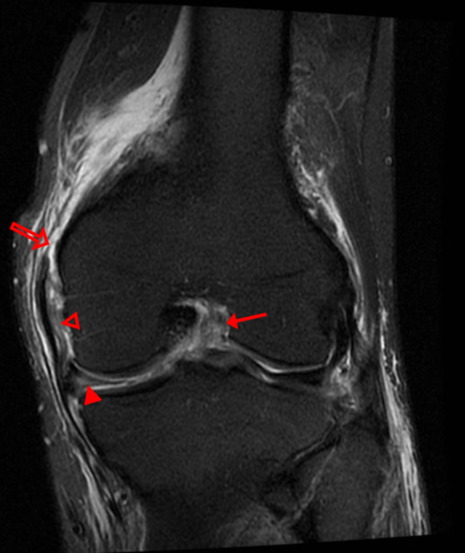 A) MRI findings: the typical bunched medial collateral ligament