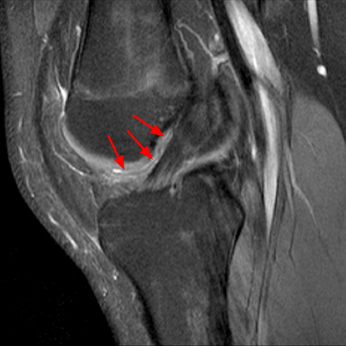 Synovial Plicae of the Knee Radsource