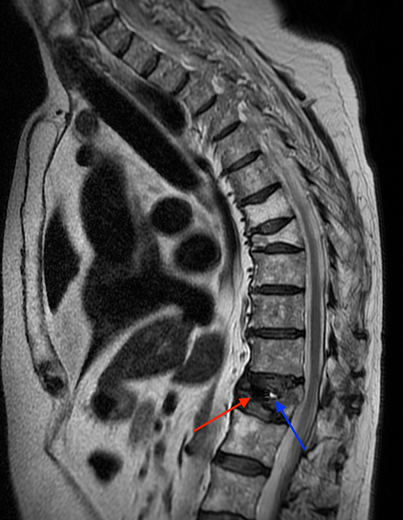 CT Scan of Lumbar Vertebral Column With L1 Vertebral Compression Fracture