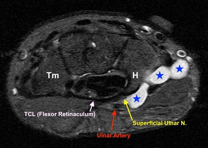 Ulnar Neuropathy: Background, Anatomy, Pathophysiology
