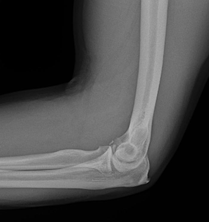 Posteromedial Rotatory Instability of the Elbow - Radsource