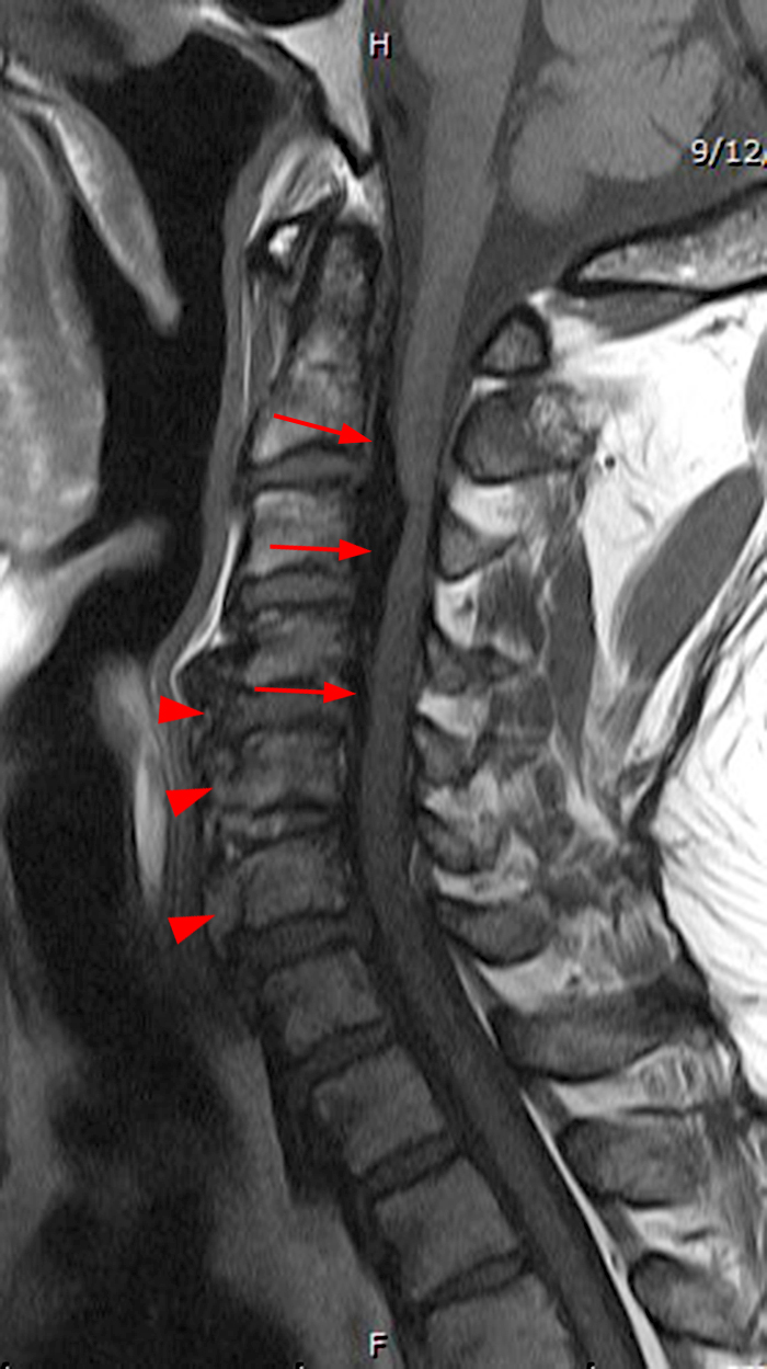 a) Preoperative findings. A 41-year-old woman with an elastic, hard