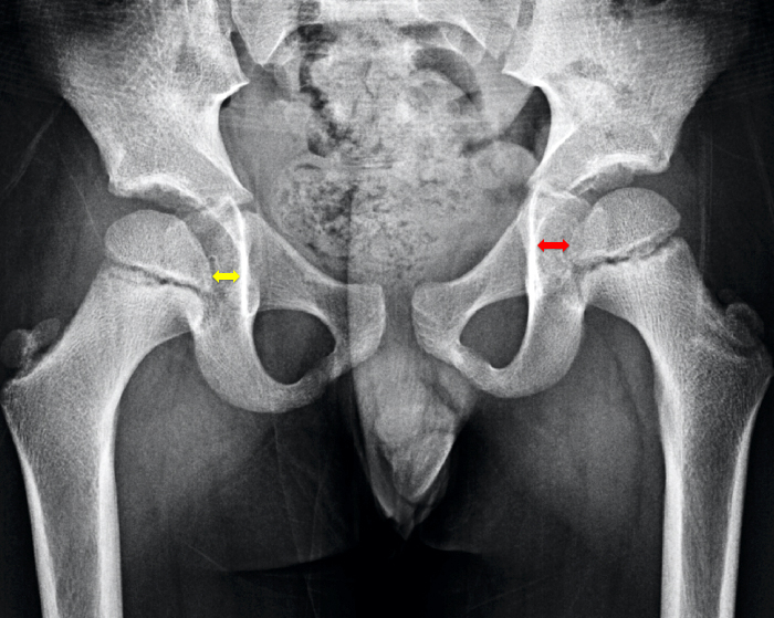 abnormal hip x ray