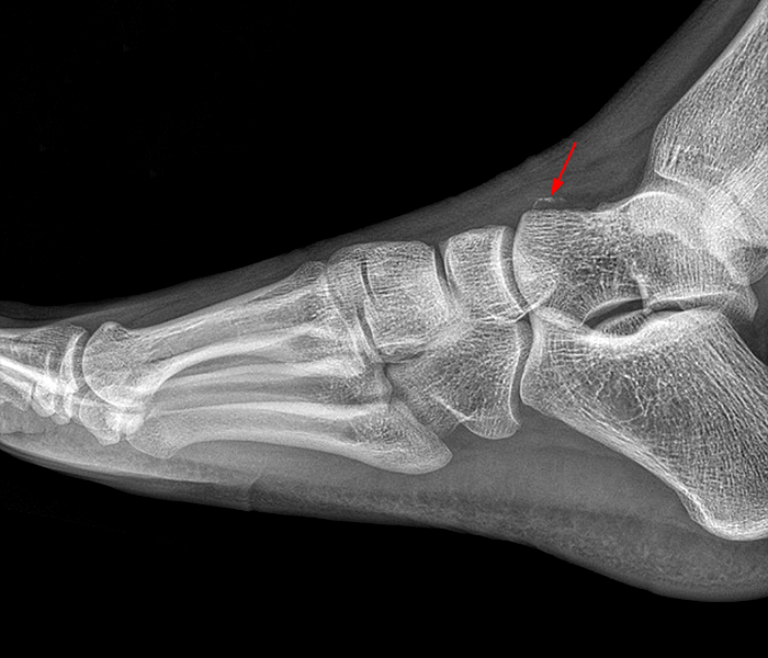 Imaging of Chopart (Midtarsal) Joint Complex: Normal Anatomy and  Posttraumatic Findings