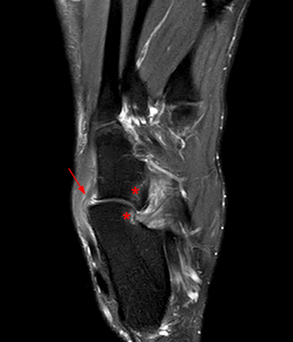 Imaging of Chopart (Midtarsal) Joint Complex: Normal Anatomy and