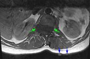 Dural Ectasia Mri Dural Ectasia Marfan Syndrome BYTKCK Dural Ectasia Mri Dural Ectasia Marfan Syndrome BYTKCK