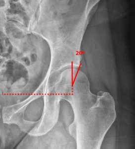 Medical image showing cropped AP pelvis radiograph
