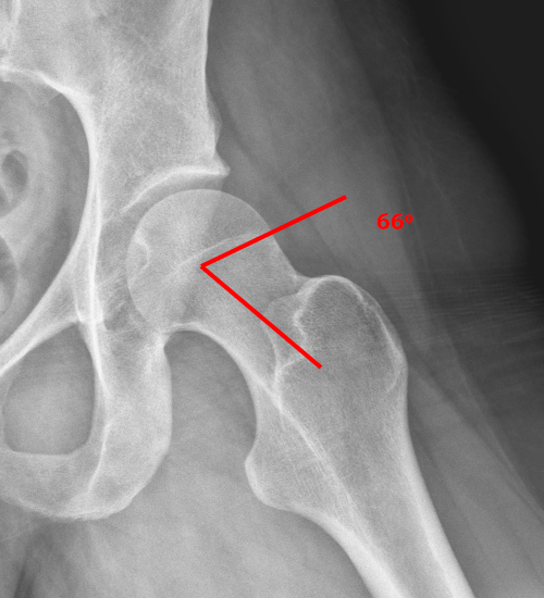 Medical image showing frog-lateral radiograph of the hip