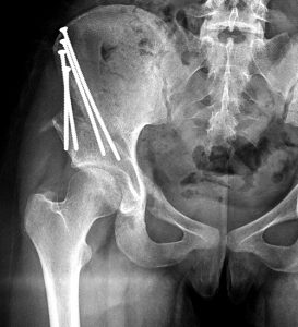 Medical image: AP pelvic radiograph demonstrating post-operative changes of the PAO.