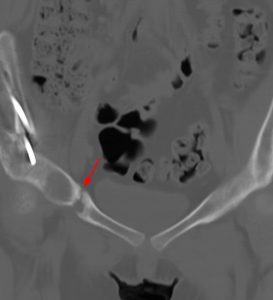 Medical image: Coronal CT reconstruction through the anterior pelvis demonstrating incomplete healing across the superior public ramus osteotomy