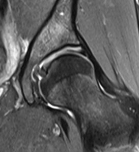 MRI image of hip