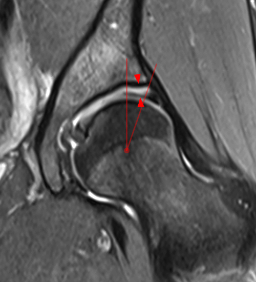 Coronal fat-suppressed proton density-weighted image of hip
