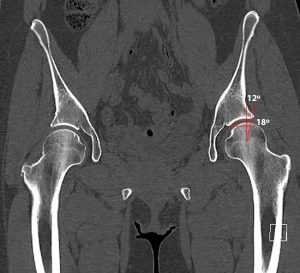 CT image of the hip