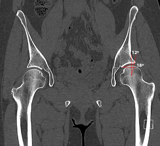 CT image of the hip