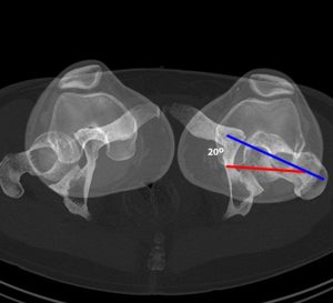 Medical image of the hip