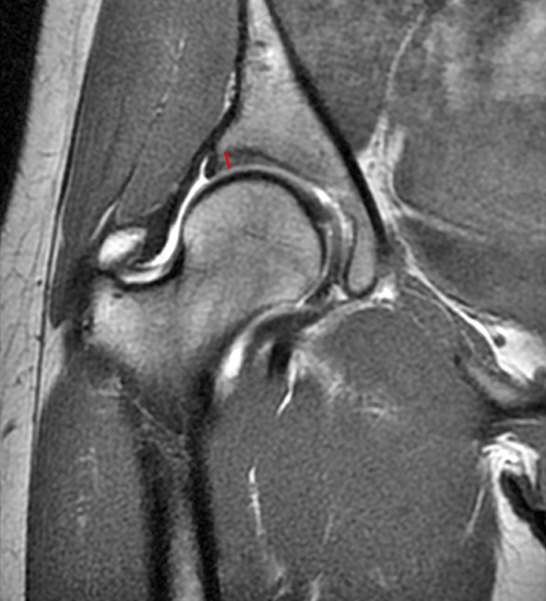 Coronal and fat-suppressed T1 image of hip