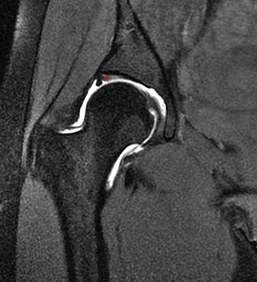 Medical image from an MR arthrogram of hip