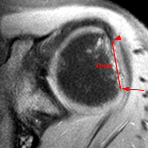 Medical image of shoulder: Hill-Sachs interval