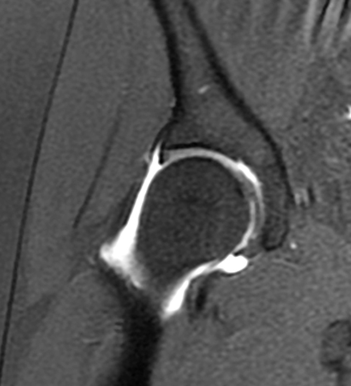 Comparison coronal MR arthrogram image of hip